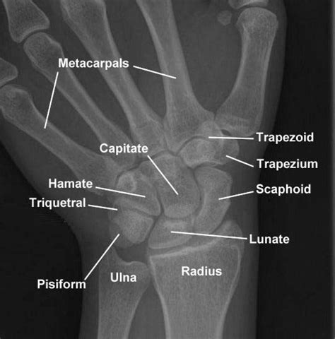 X Ray Image Showing The Left Hand Wrist In Dorsal View The Carpal