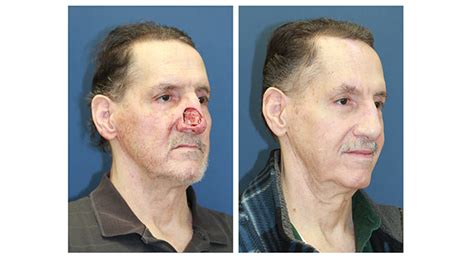 Types Of Facial Reconstructive Plastic Surgery Telegraph