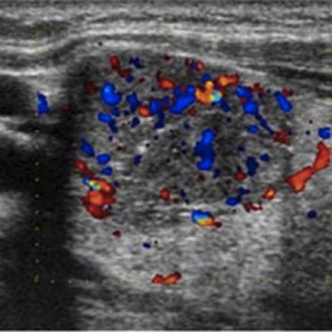 Ultrasound Image Of A Malignant Thyroid Nodule Showing A Download