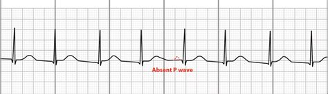 Ekg Junctional Rhythms And Bradycardia Accelerate Junctional Leveluprn