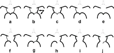 Anatomic Variations Of The Posterior Part Of The Circle Of Willis