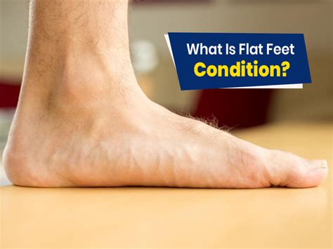 Flat Feet Symptoms Causes And Risks Onlymyhealth