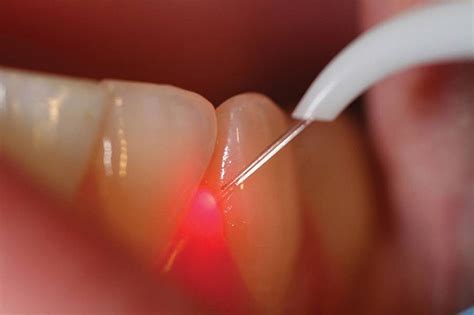 The Use Of Laser For Gum Treatment And Other Dentistry Applications