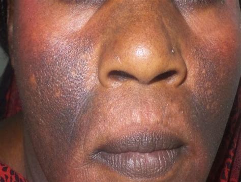 Dermdx Dark Skin Patches Clinical Advisor