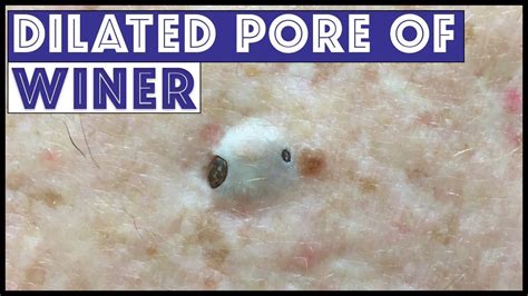 Dilated Pore Of Winer Giant Blackhead With Dr Pimple Popper Youtube