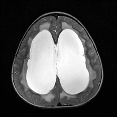 Dandy Walker Malformation Radiology Case Dandy