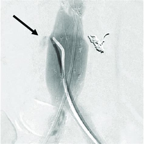 Deployment Of Palmaz Xl Stent In Proximal Aortic Neck Download