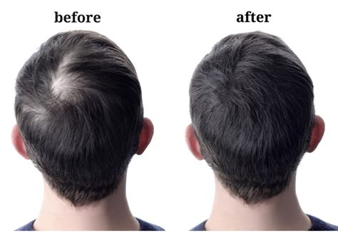 Remedies To Regrow Hair On Bald Patches Easily At Home
