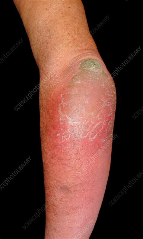 Bursitis Of The Elbow Stock Image C0373029 Science Photo Library