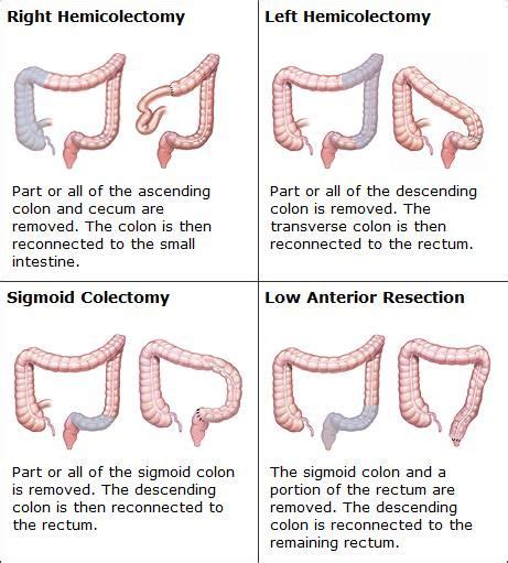 Types Of Colon Resections Articles Mount Nittany Health System
