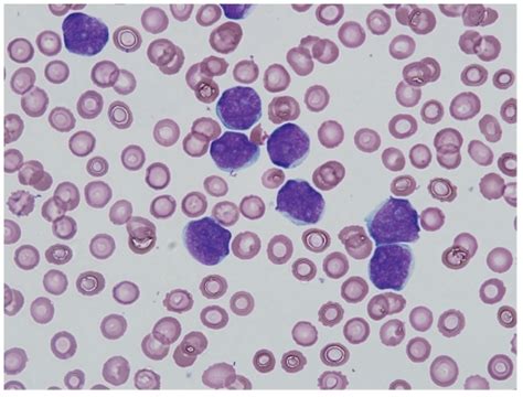 The Peripheral Blood Smear Shows An Increased Number Of Medium To