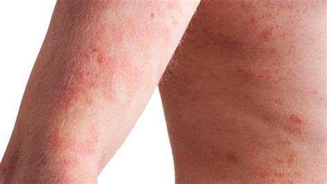 Inverse Psoriasis Pictures Causes And Treatments