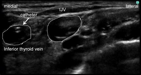 Ultrasound Image Of The Right Supraclavicular Fossa The Catheter Is