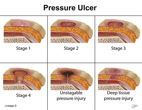 Heel Pressure Ulcer Stages