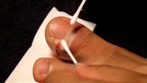 Popping Huge Infected Toe Pimple Youtube