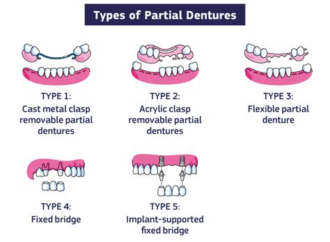 Partial Dentures And Everything You Need To Know About Them