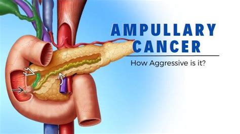 How Aggressive Is Ampullary Cancer