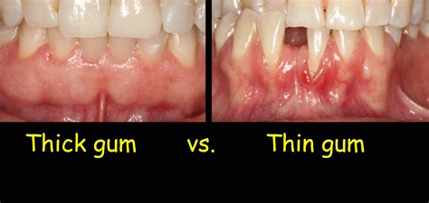How Your Gums Should Look