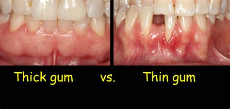 How Your Gums Should Look