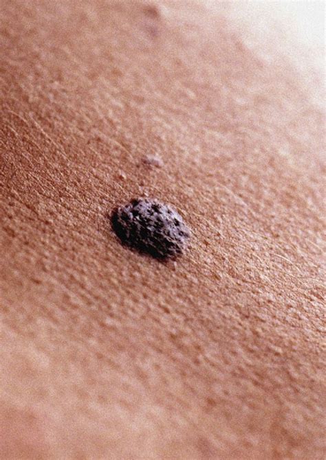 Number Of Moles On Right Arm Predicts Skin Cancer Risk