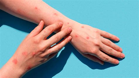 Symptoms And Causes Of Smallpox Onlymyhealth