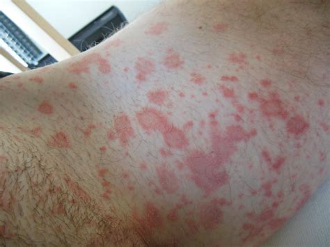 What Does A Gradually Spreading Rash On The Groin Indicate
