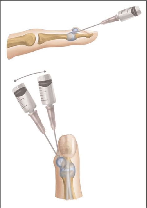 Figure 1 From Percutaneous Capsulotomy For Treatment Of Digital Mucous