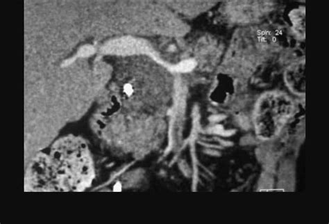 Pancreatic Adenocarcinoma Imaging What You Need To Know
