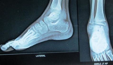 Osteolytic Lesion In Talus Download Scientific Diagram