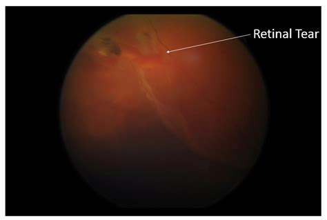 Retina Consultants Of Boston Preserving The T Of Sight
