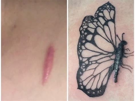 People Are Getting Medical Tattoos To Cover Scars From Surgeries