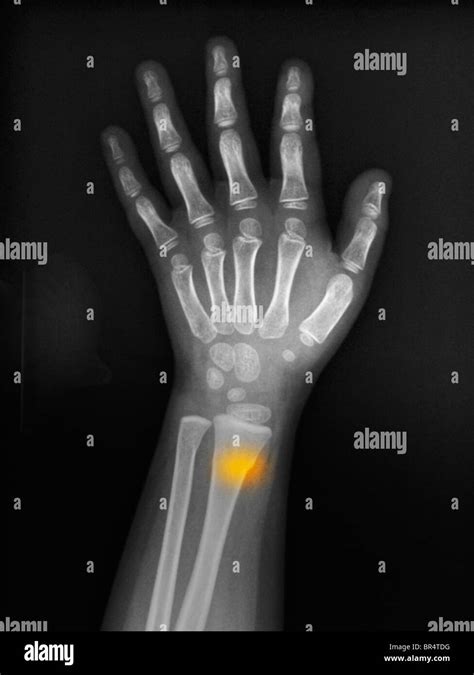 Forearm X Ray Of A 3 Year Old Girl Showing A Buckle Greenstick Stock