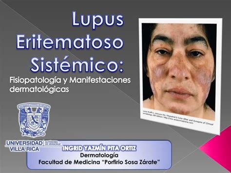 Lupus Eritematoso SistÉmico Fisiopatología Y Manifestaciones