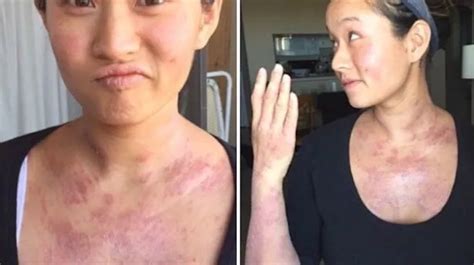 Woman Reveals How Boob Job Left Her With Eczema So Severe She Was