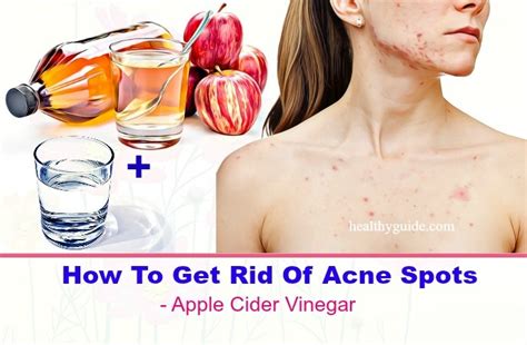 Tips How To Get Rid Of Acne Spots On Face Back Arms And Chest Overnight