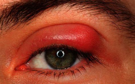 Stye On Eyelid Pictures Causes How To Get Rid Treatment