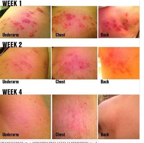 Shingles Rodan And Fields Soothe Regimen Has This Affect On Shingles
