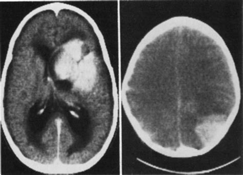 Primary Cerebral Neuroblastoma In Journal Of Neurosurgery Volume 59