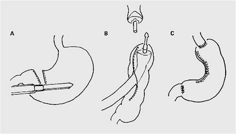 Figure 1 From Proximal Gastrectomy And Gastric Tube Reconstruction For