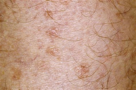 Skin Rash After Methotrexate Drug Stock Image C0135883 Science