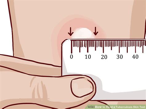 How To Read A Tuberculosis Skin Test 9 Steps With Pictures