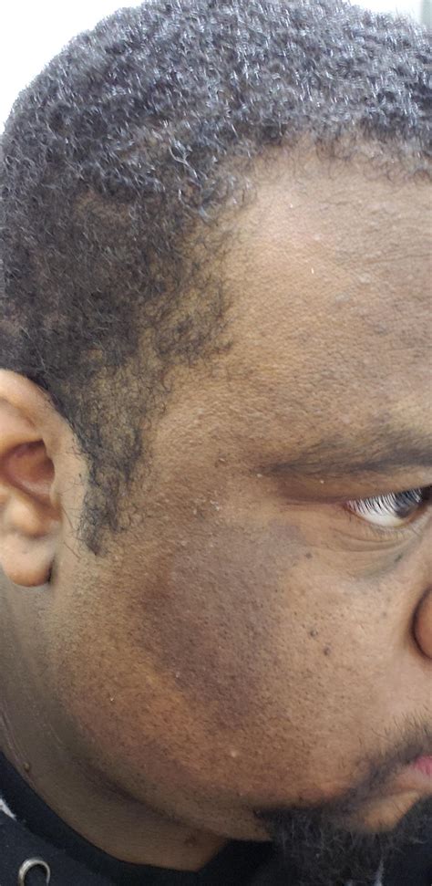 Black Spots On Skin Causes