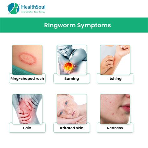 Ringworm Symptoms Diagnosis And Treatment Dermatology Healthsoul