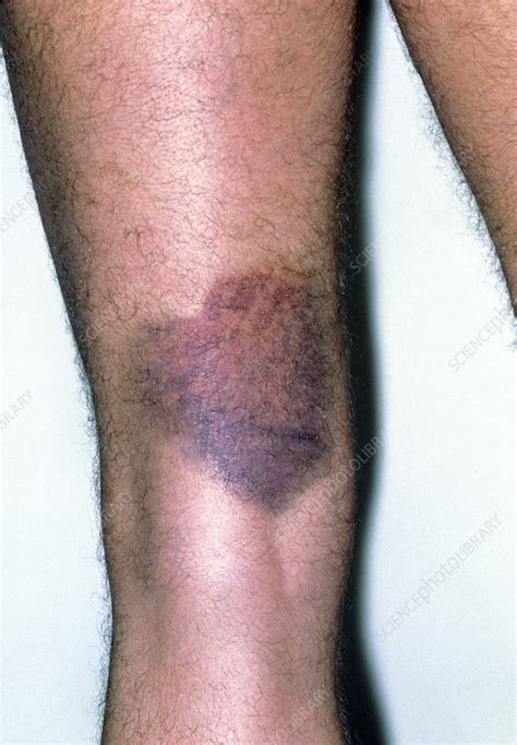 Bruising Behind Mans Knee Due To Torn Hamstring Stock Image M330