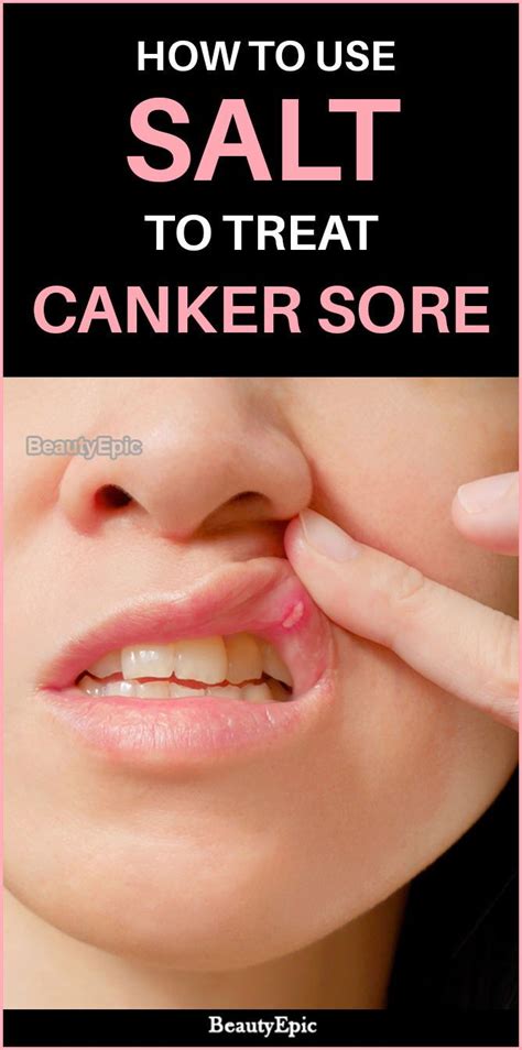 How Does Salt Help Heal Canker Sores Canker Sore Canker Sore Remedy