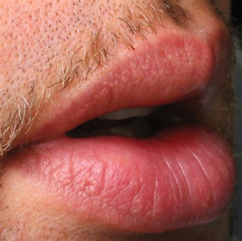 Small Bumps On Lips Core Plastic Surgery