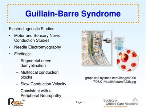 Guillain Barre Syndrome Concept Map