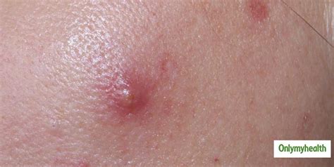 Chest Acne Dermatologist Explains What Causes Chest Acne And How You