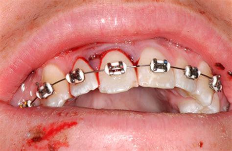 How to fix a broken tooth at home dr. Splinting of teeth following trauma: a review and a new splinting recommendation - Kahler - 2016 ...