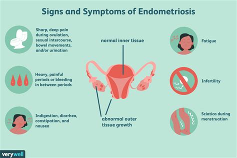 common symptoms or signs of endometriosis fabbricabois